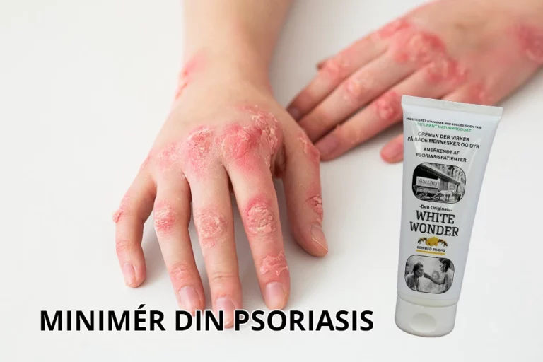 Psoriasis-Featured-Image