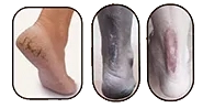 Før og efter billeder af tørre og sprukne fødder